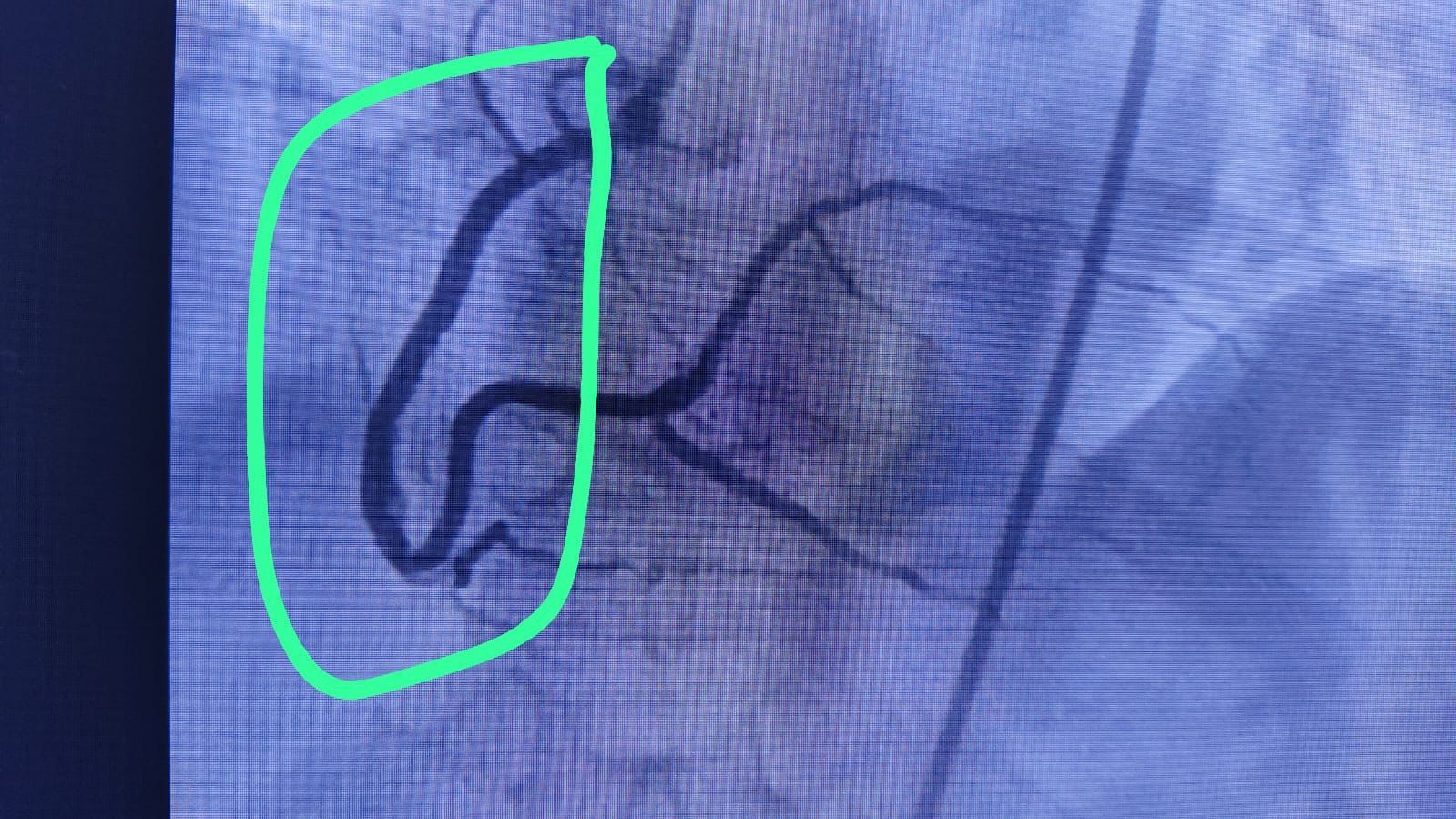 Medical Angiogram Image 6